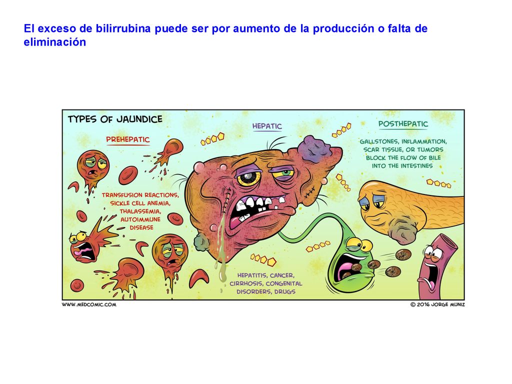 El exceso de bilirrubina puede ser por aumento de la producción o falta de eliminación