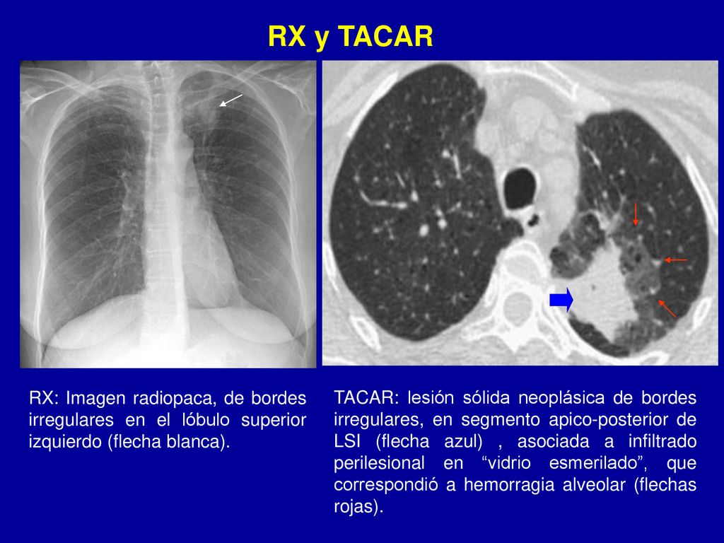 RX y TACAR RX: Imagen radiopaca, de bordes irregulares en el lóbulo superior izquierdo (flecha blanca).