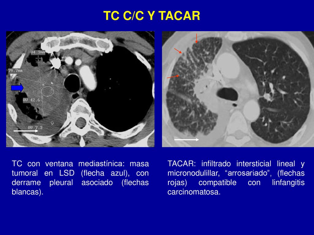 TC C/C Y TACAR TC con ventana mediastínica: masa tumoral en LSD (flecha azul), con derrame pleural asociado (flechas blancas).