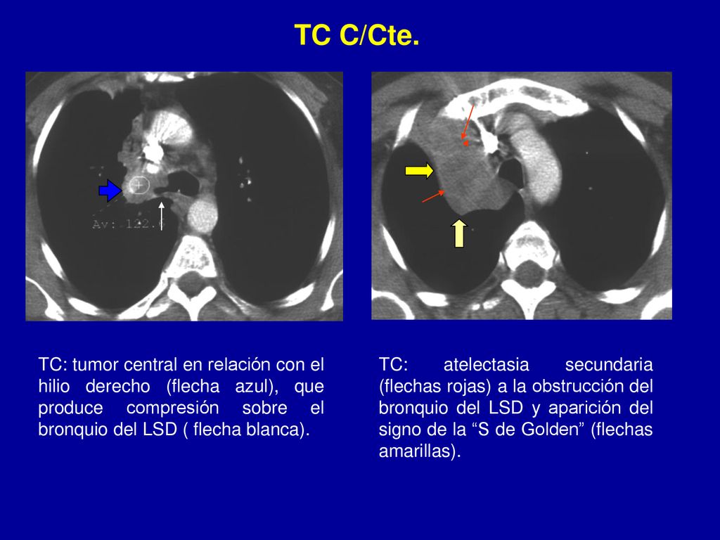 TC C/Cte. TC: tumor central en relación con el hilio derecho (flecha azul), que produce compresión sobre el bronquio del LSD ( flecha blanca).