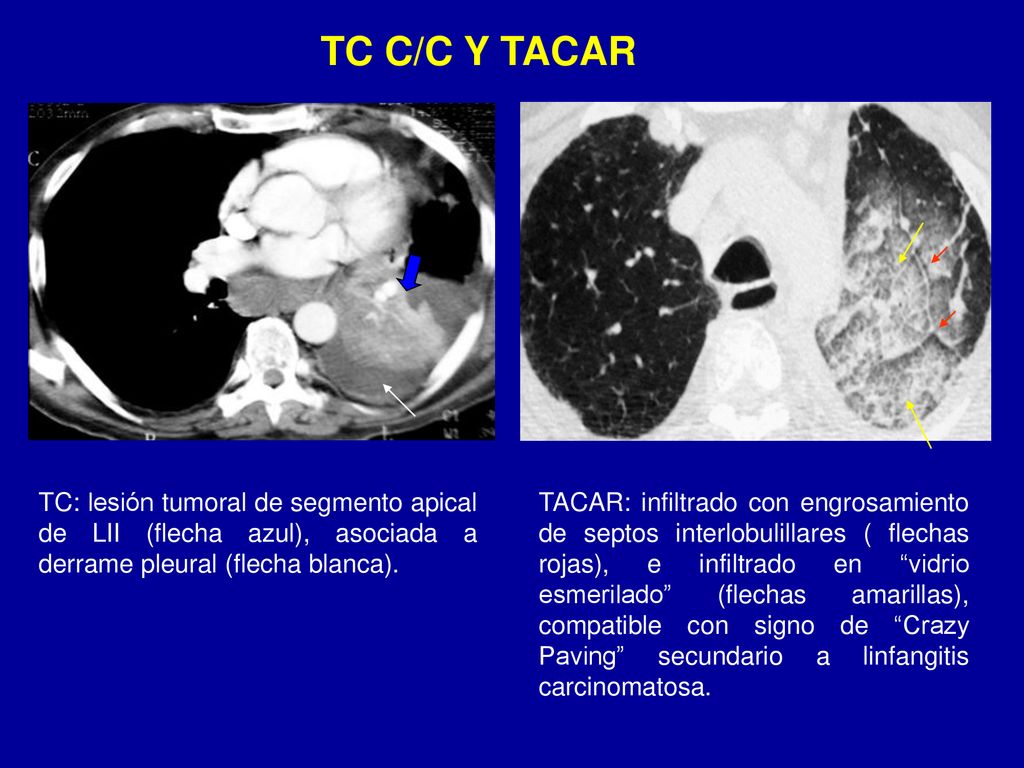 TC C/C Y TACAR TC: lesión tumoral de segmento apical de LII (flecha azul), asociada a derrame pleural (flecha blanca).