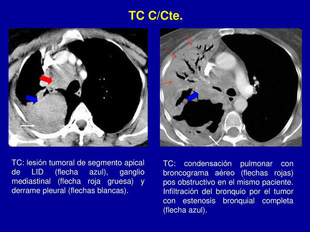 TC C/Cte. TC: lesión tumoral de segmento apical de LID (flecha azul), ganglio mediastinal (flecha roja gruesa) y derrame pleural (flechas blancas).
