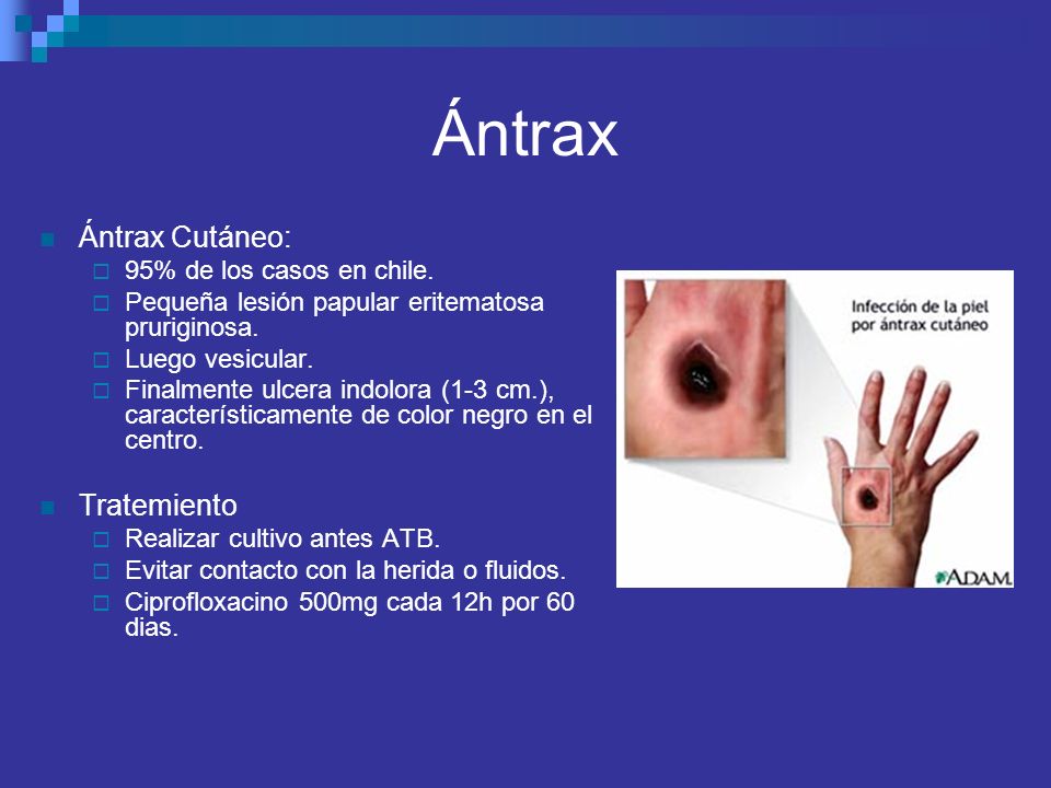 Ántrax Ántrax Cutáneo: Tratemiento 95% de los casos en chile.