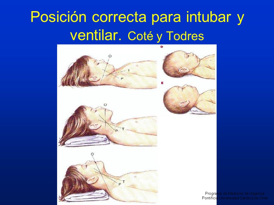Posición correcta para intubar y ventilar. Coté y Todres