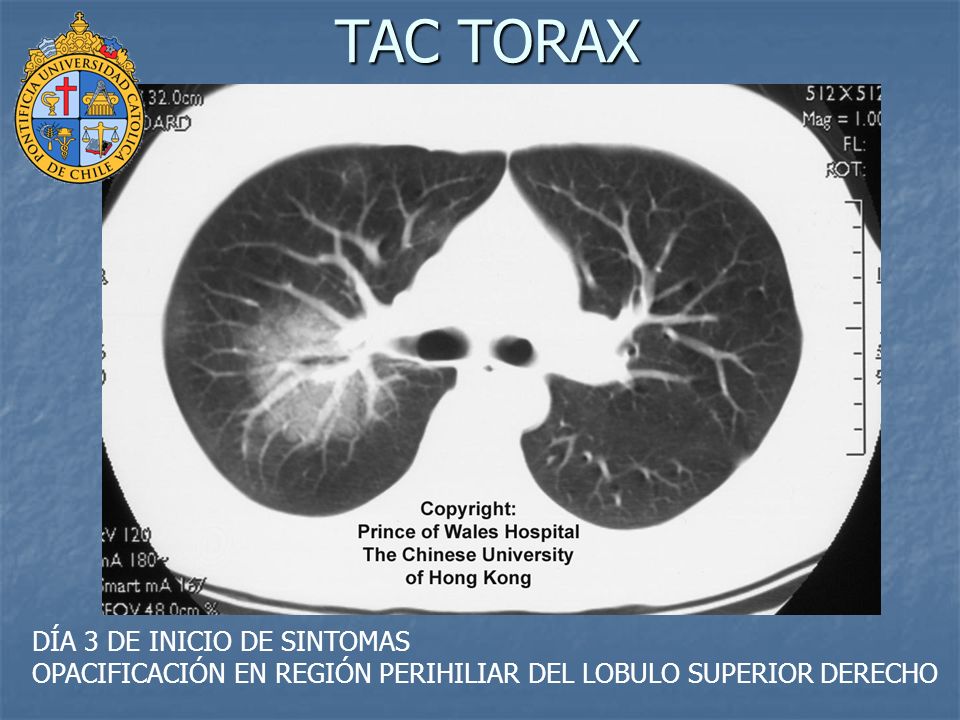 TAC TORAX DÍA 3 DE INICIO DE SINTOMAS OPACIFICACIÓN EN REGIÓN PERIHILIAR DEL LOBULO SUPERIOR DERECHO.