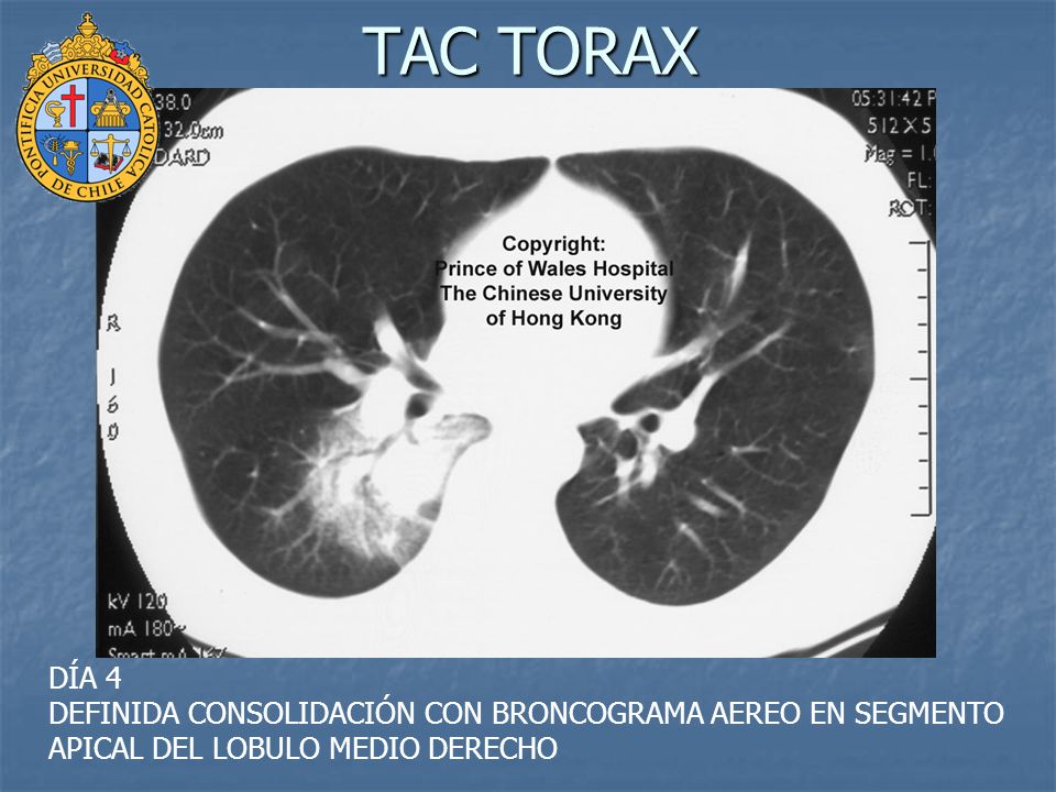 TAC TORAX DÍA 4 DEFINIDA CONSOLIDACIÓN CON BRONCOGRAMA AEREO EN SEGMENTO APICAL DEL LOBULO MEDIO DERECHO.