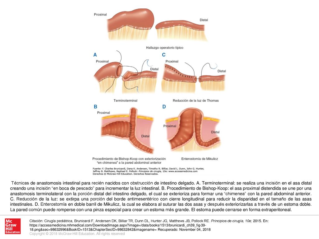 Técnicas de anastomosis intestinal para recién nacidos con obstrucción de intestino delgado. A. Terminoterminal: se realiza una incisión en el asa distal creando una incisión en boca de pescado para incrementar la luz intestinal. B. Procedimiento de Bishop-Koop: el asa proximal distendida se une por una anastomosis terminolateral con la porción distal del intestino delgado, el cual se exterioriza para formar una chimenea con la pared abdominal anterior. C. Reducción de la luz: se extirpa una porción del borde antimesentérico con cierre longitudinal para reducir la disparidad en el tamaño de las asas intestinales. D. Enterostomía en doble barril de Mikulicz, la cual se elabora al suturar las dos asas y después exteriorizarlas a través de un estoma doble. La pared común puede romperse con una pinza especial para crear un estoma más grande. El estoma puede cerrarse en forma extraperitoneal.