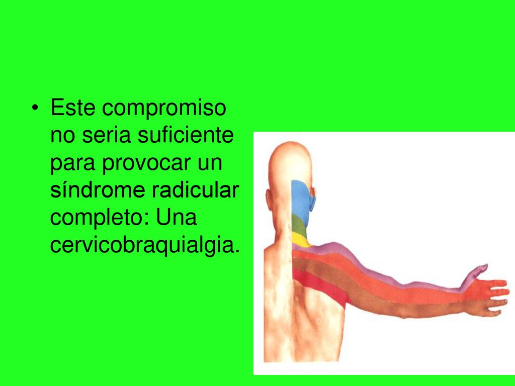 Este compromiso no seria suficiente para provocar un síndrome radicular completo: Una cervicobraquialgia.