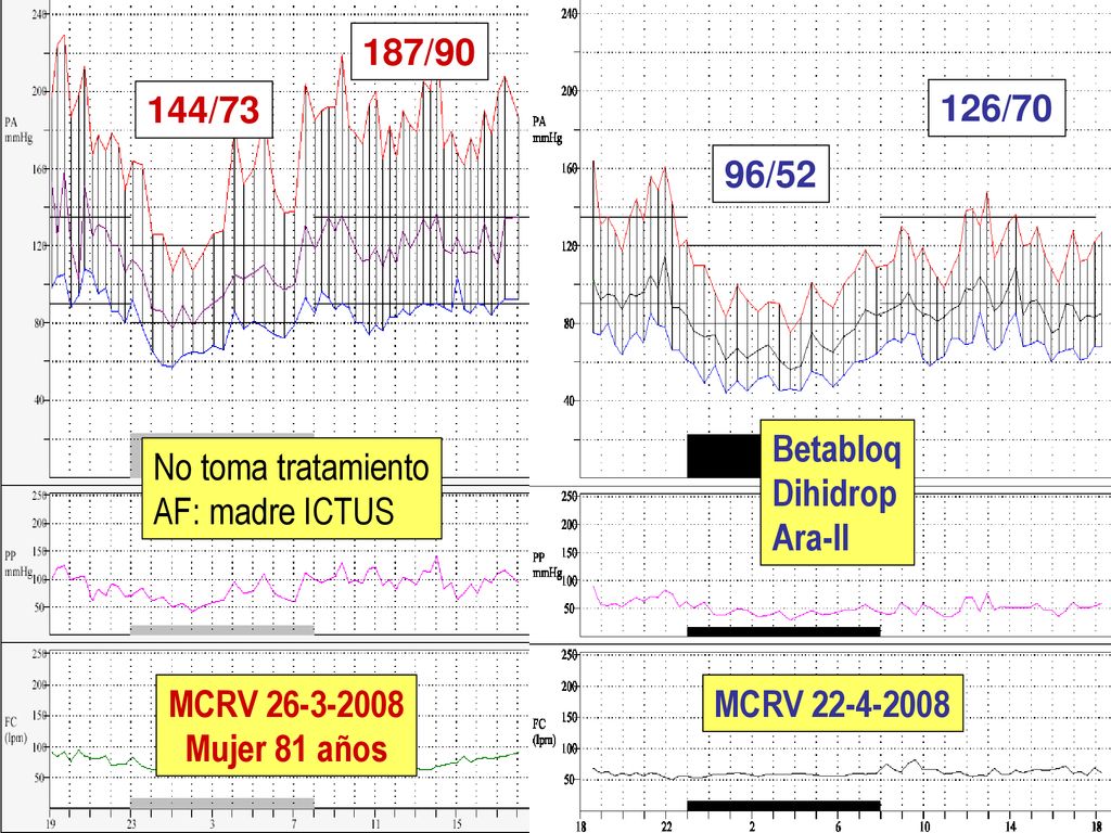 187/90 144/ /70. 96/52. Betabloq. Dihidrop. Ara-II. No toma tratamiento. AF: madre ICTUS.