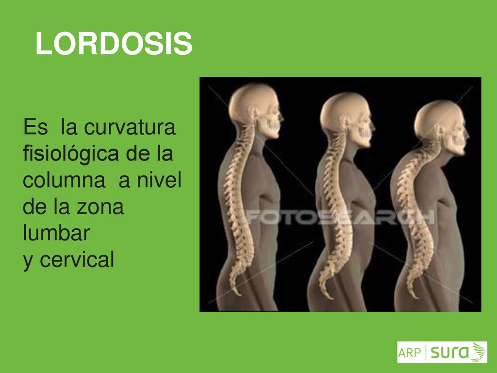 LORDOSIS Es la curvatura fisiológica de la columna a nivel