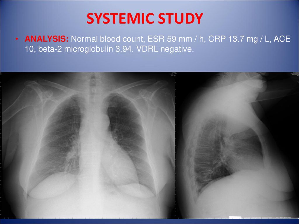SYSTEMIC STUDY ANALYSIS: Normal blood count, ESR 59 mm / h, CRP 13.7 mg / L, ACE 10, beta-2 microglobulin 3.94.