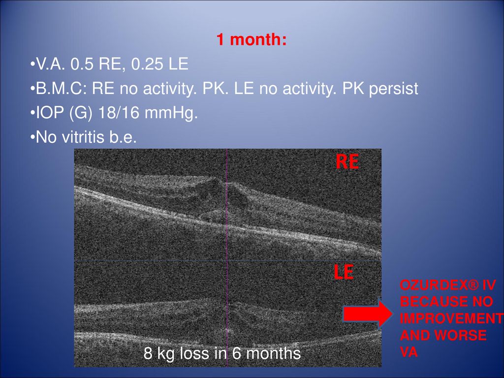 1 month: V.A. 0.5 RE, 0.25 LE. B.M.C: RE no activity. PK. LE no activity. PK persist. IOP (G) 18/16 mmHg.