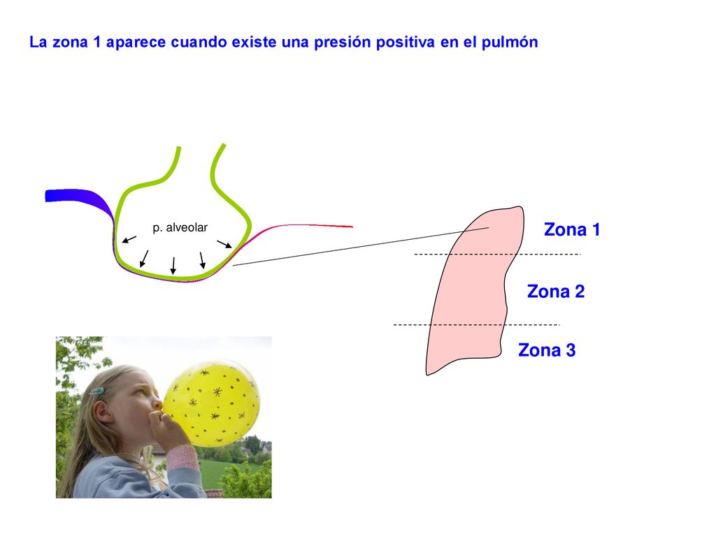 La zona 1 aparece cuando existe una presión positiva en el pulmón