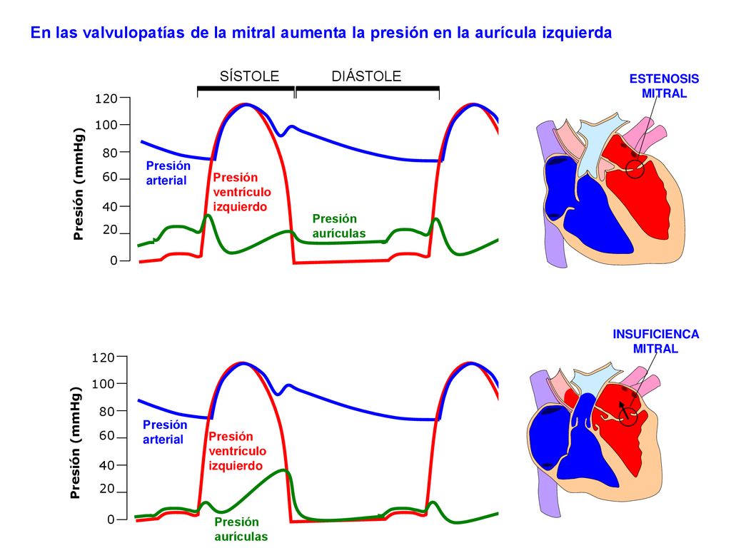 En las valvulopatías de la mitral aumenta la presión en la aurícula izquierda