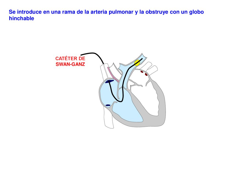 Se introduce en una rama de la arteria pulmonar y la obstruye con un globo hinchable