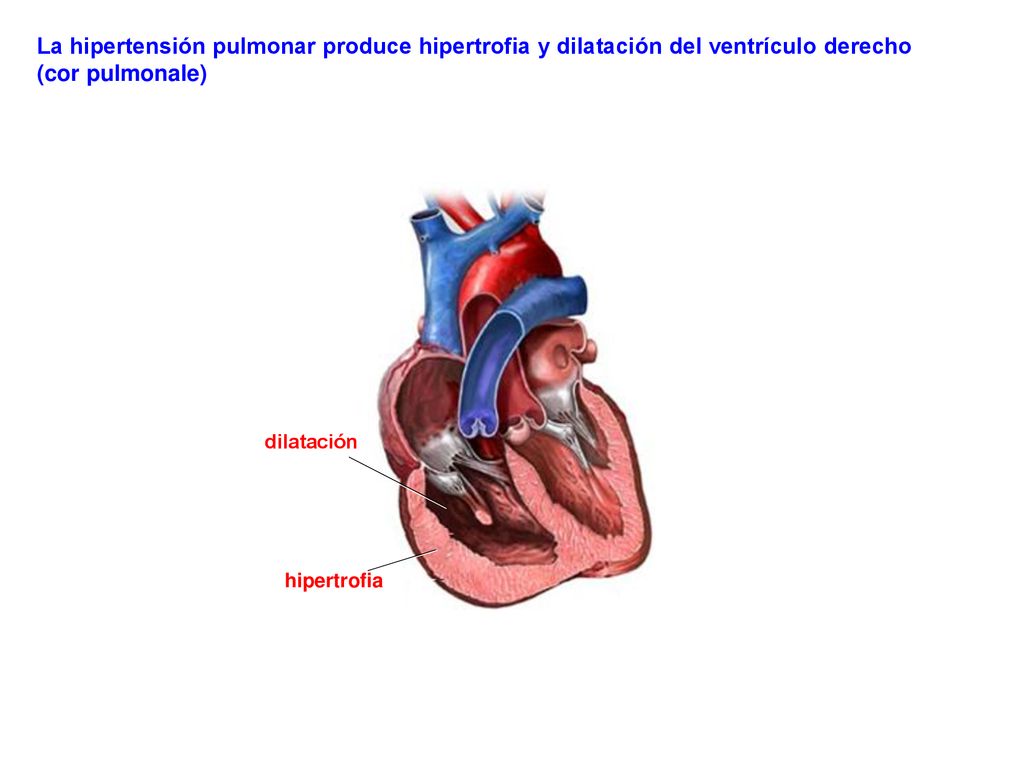 La hipertensión pulmonar produce hipertrofia y dilatación del ventrículo derecho (cor pulmonale)