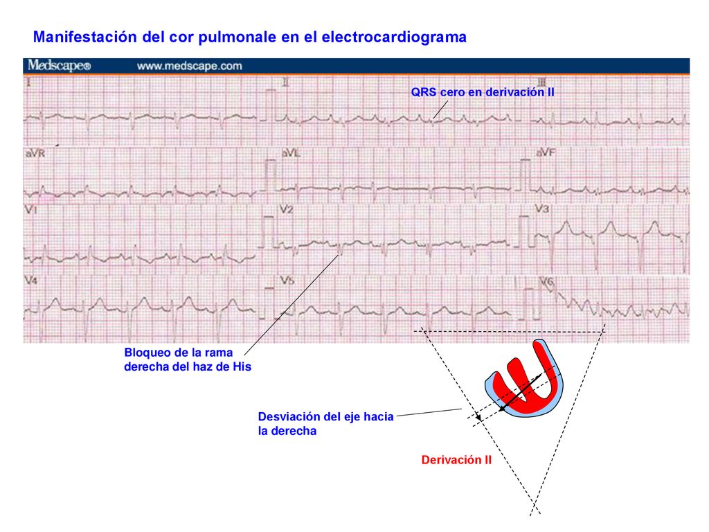 Manifestación del cor pulmonale en el electrocardiograma
