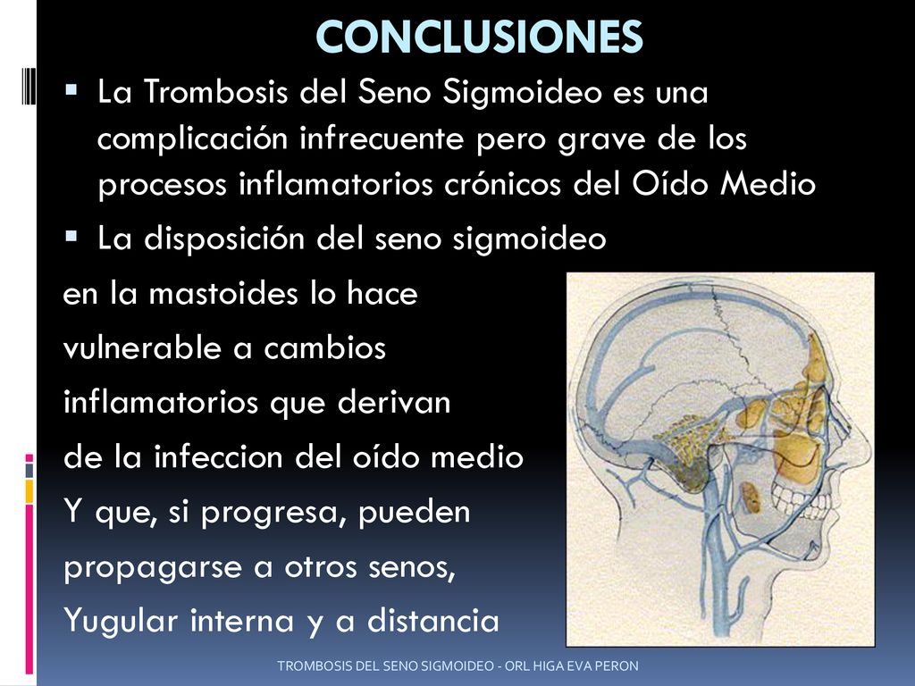 CONCLUSIONES La Trombosis del Seno Sigmoideo es una complicación infrecuente pero grave de los procesos inflamatorios crónicos del Oído Medio.