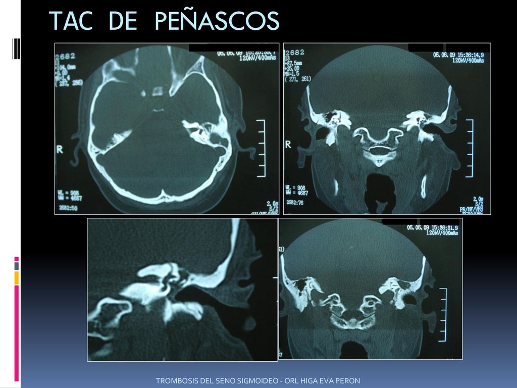 TAC DE PEÑASCOS TROMBOSIS DEL SENO SIGMOIDEO - ORL HIGA EVA PERON
