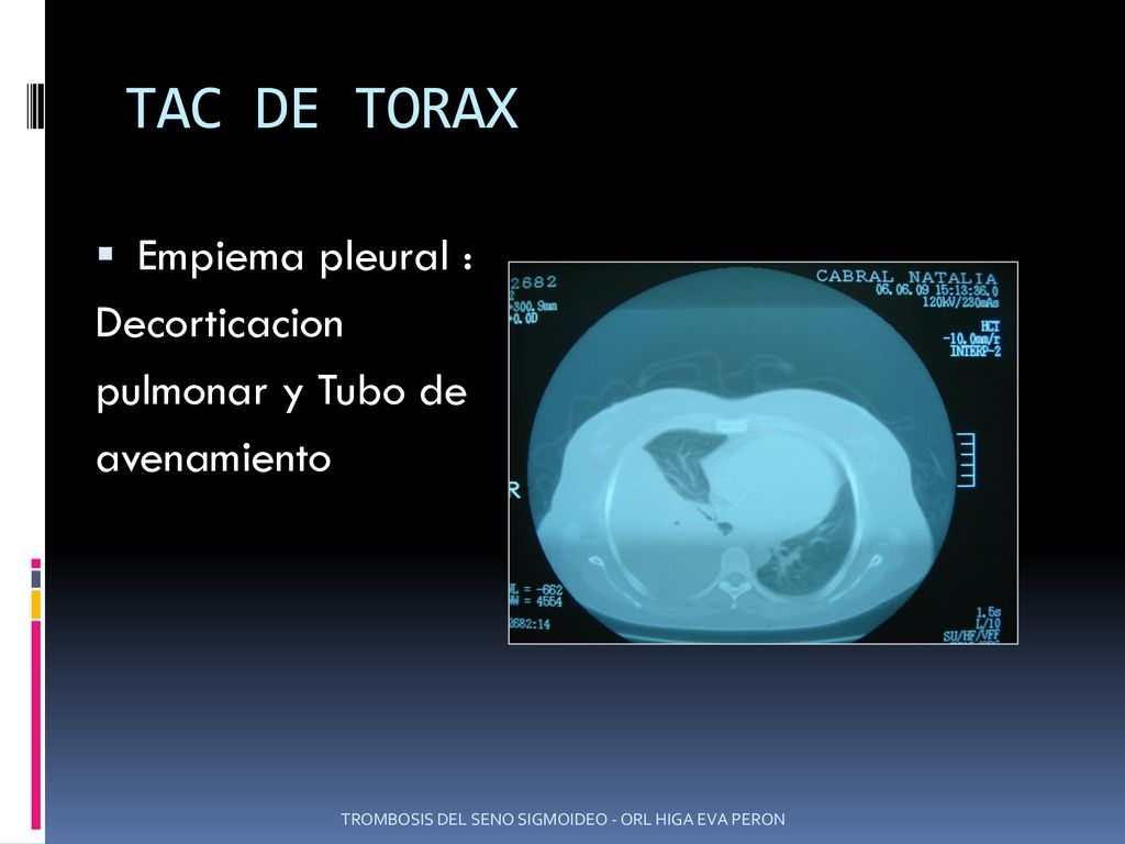 TAC DE TORAX Empiema pleural : Decorticacion pulmonar y Tubo de