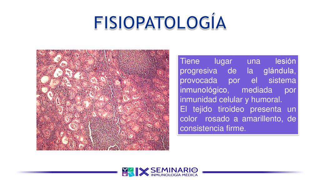 FISIOPATOLOGÍA Tiene lugar una lesión progresiva de la glándula, provocada por el sistema inmunológico, mediada por inmunidad celular y humoral.