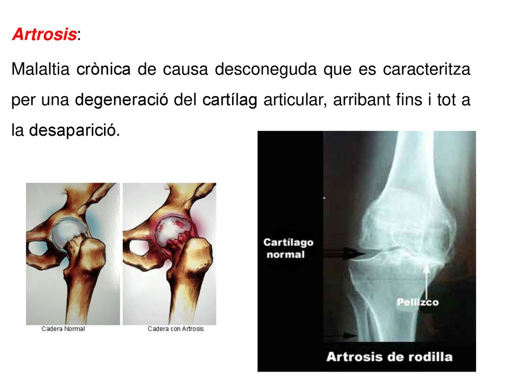 Artrosis: Malaltia crònica de causa desconeguda que es caracteritza per una degeneració del cartílag articular, arribant fins i tot a la desaparició.