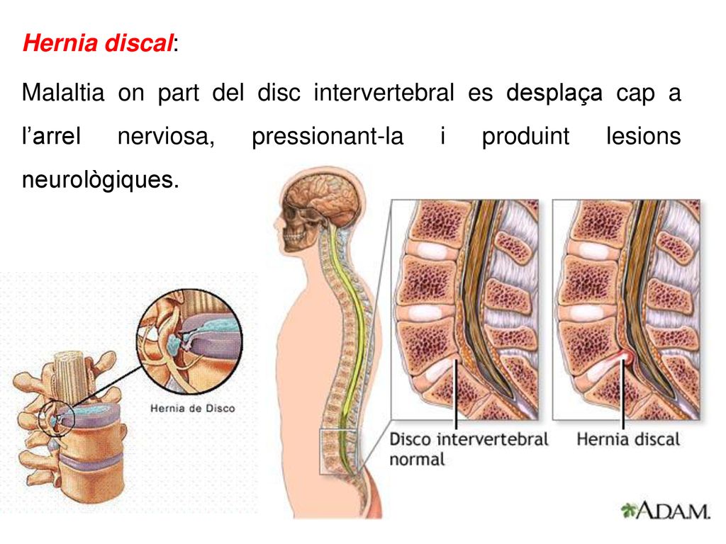 Hernia discal: Malaltia on part del disc intervertebral es desplaça cap a l’arrel nerviosa, pressionant-la i produint lesions neurològiques.