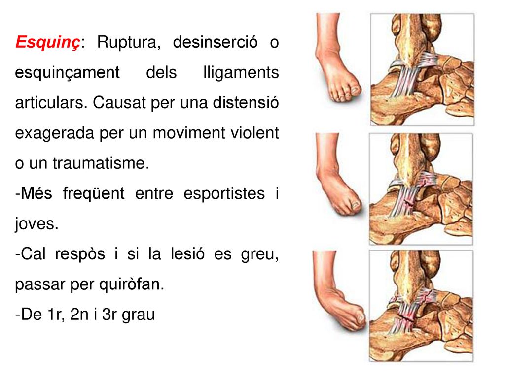 Esquinç: Ruptura, desinserció o esquinçament dels lligaments articulars. Causat per una distensió exagerada per un moviment violent o un traumatisme.