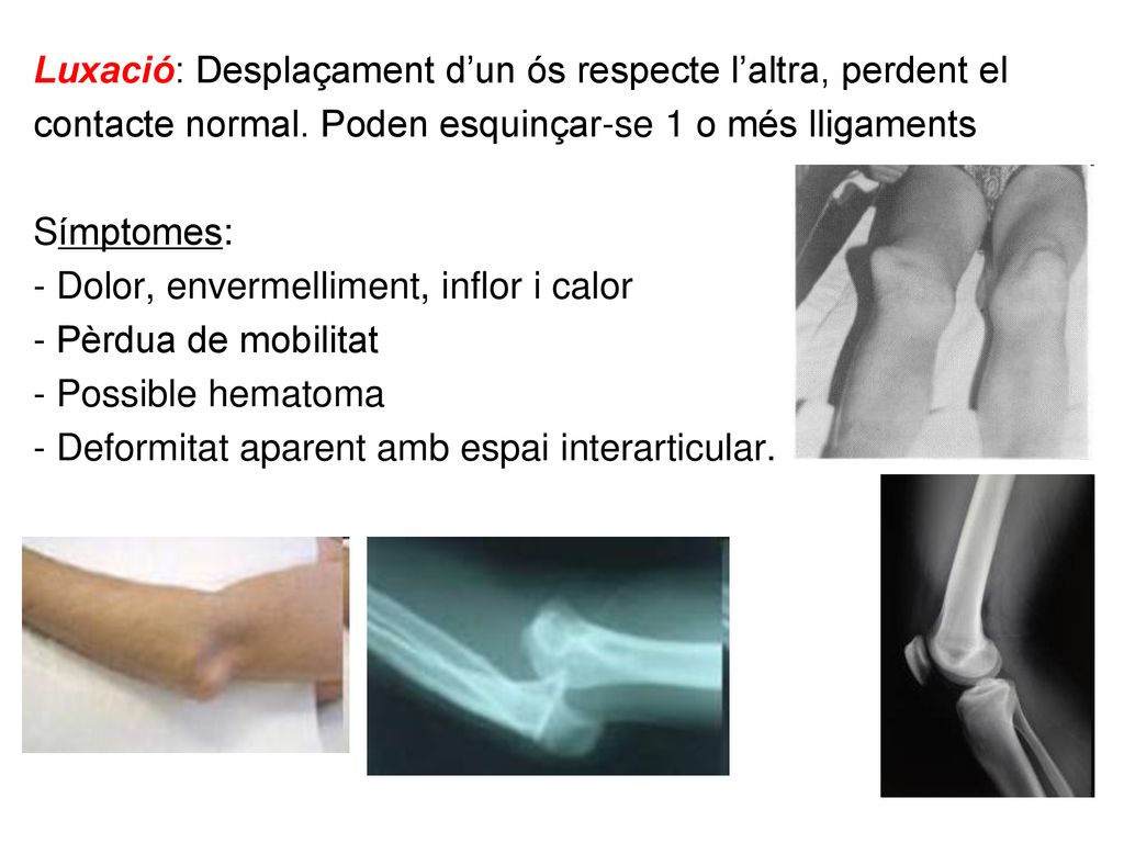 Luxació: Desplaçament d’un ós respecte l’altra, perdent el contacte normal.