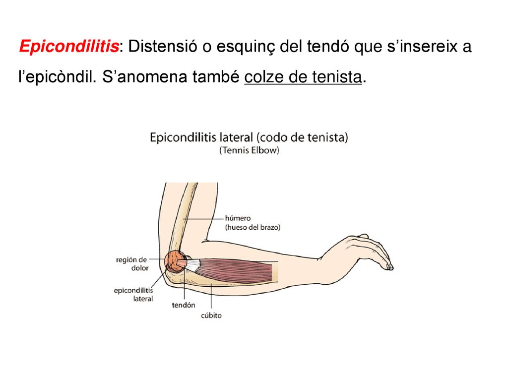 Epicondilitis: Distensió o esquinç del tendó que s’insereix a l’epicòndil.