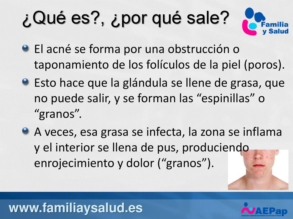 ¿Qué es , ¿por qué sale El acné se forma por una obstrucción o taponamiento de los folículos de la piel (poros).