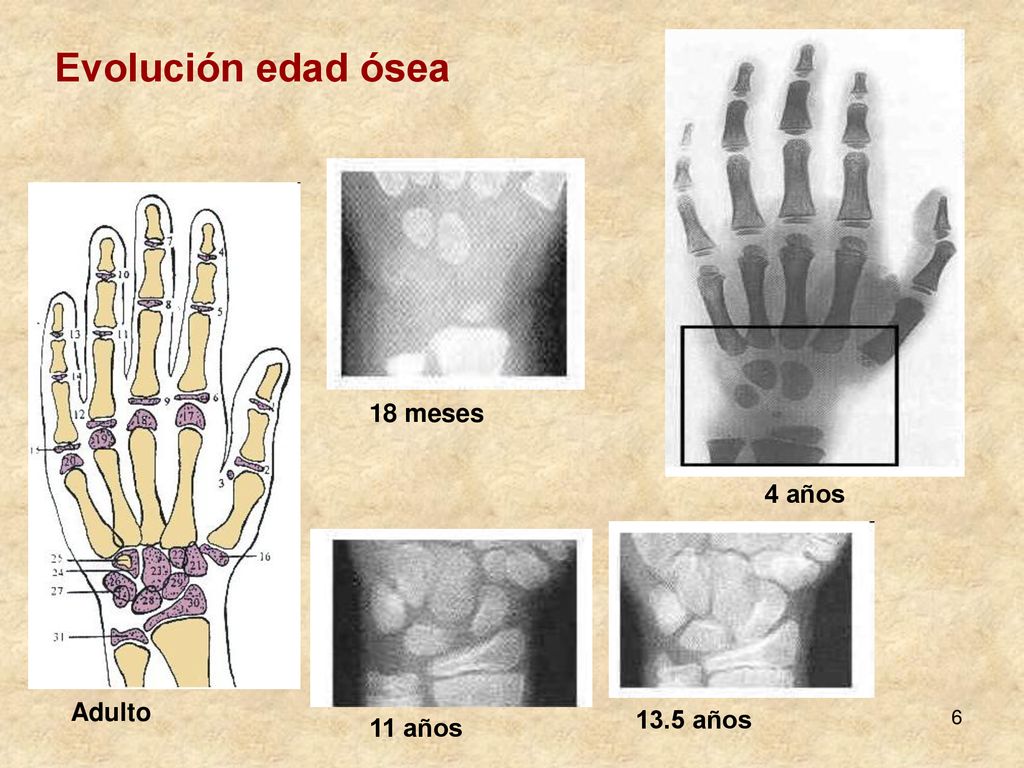 Evolución edad ósea 18 meses 4 años Adulto 13.5 años 11 años