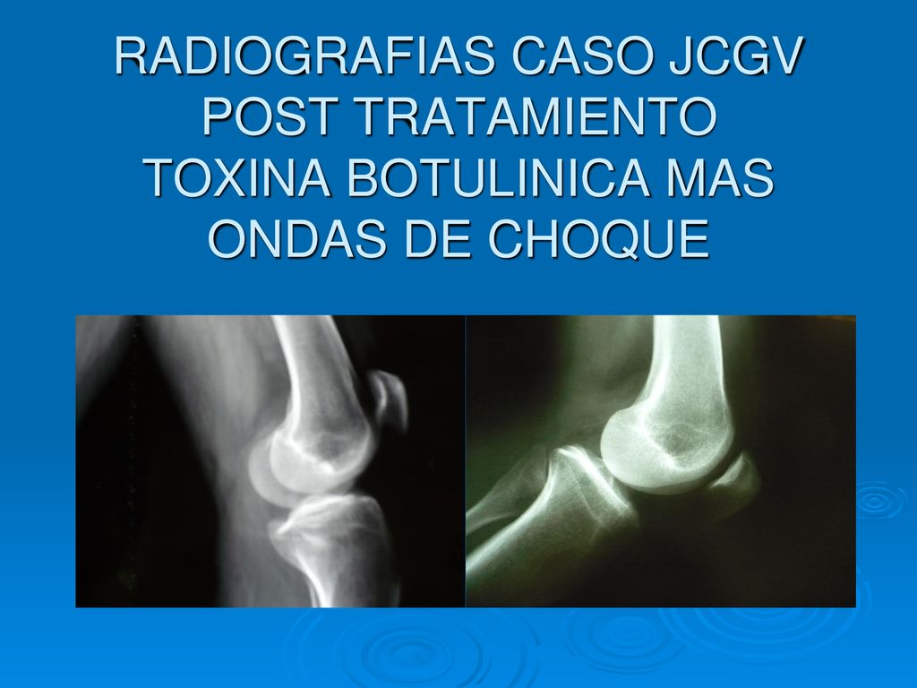 RADIOGRAFIAS CASO JCGV POST TRATAMIENTO TOXINA BOTULINICA MAS ONDAS DE CHOQUE