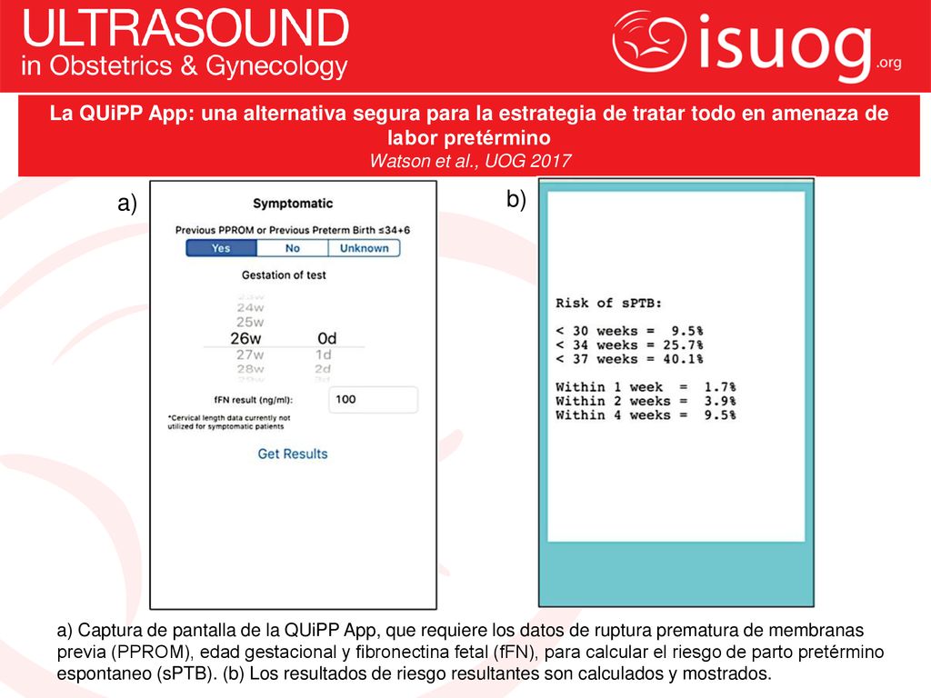 La QUiPP App: una alternativa segura para la estrategia de tratar todo en amenaza de labor pretérmino