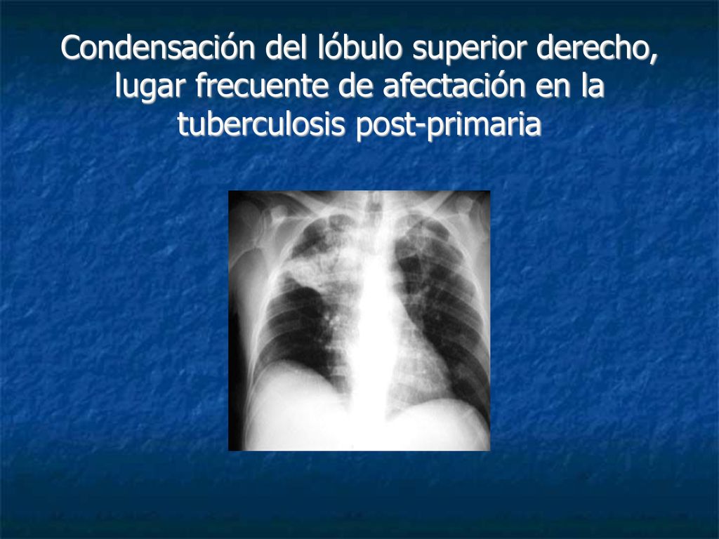 Condensación del lóbulo superior derecho, lugar frecuente de afectación en la tuberculosis post-primaria