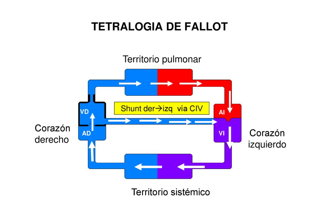 TETRALOGIA DE FALLOT Territorio pulmonar Corazón derecho