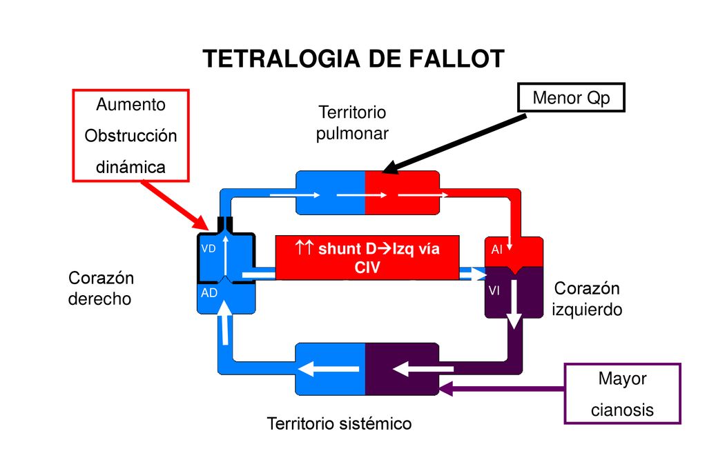 TETRALOGIA DE FALLOT Menor Qp Aumento Territorio pulmonar Obstrucción