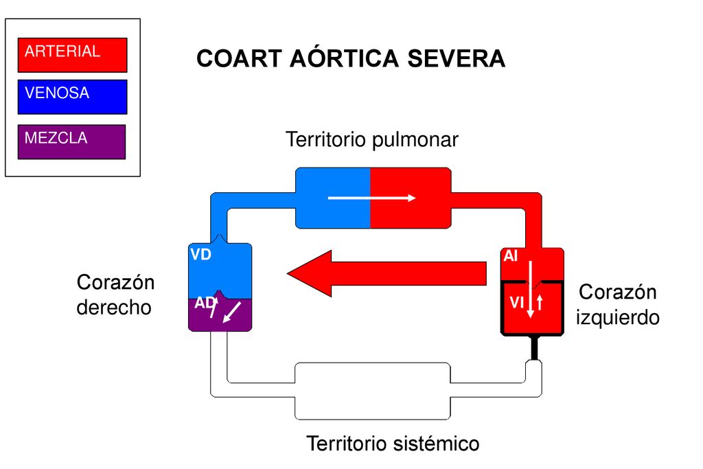 COART AÓRTICA SEVERA Territorio pulmonar Corazónderecho