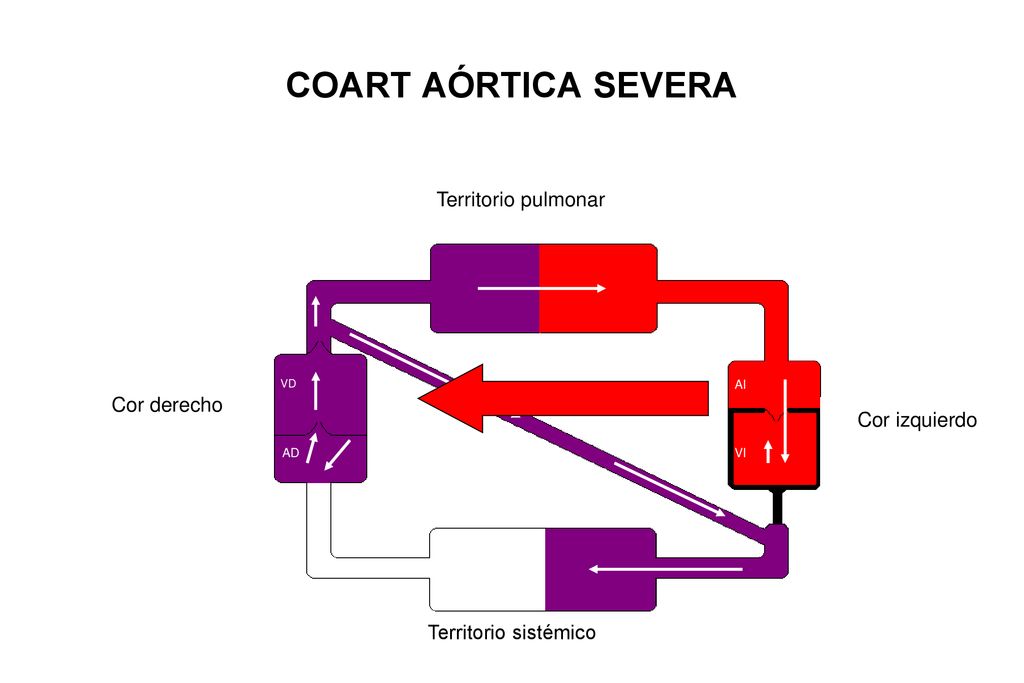 COART AÓRTICA SEVERA Territorio pulmonar Cor derecho Cor izquierdo