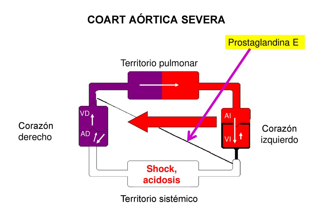 COART AÓRTICA SEVERA Prostaglandina E Territorio pulmonar