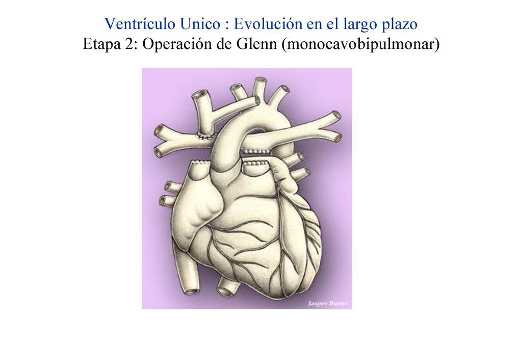 Ventrículo Unico : Evolución en el largo plazo Etapa 2: Operación de Glenn (monocavobipulmonar)