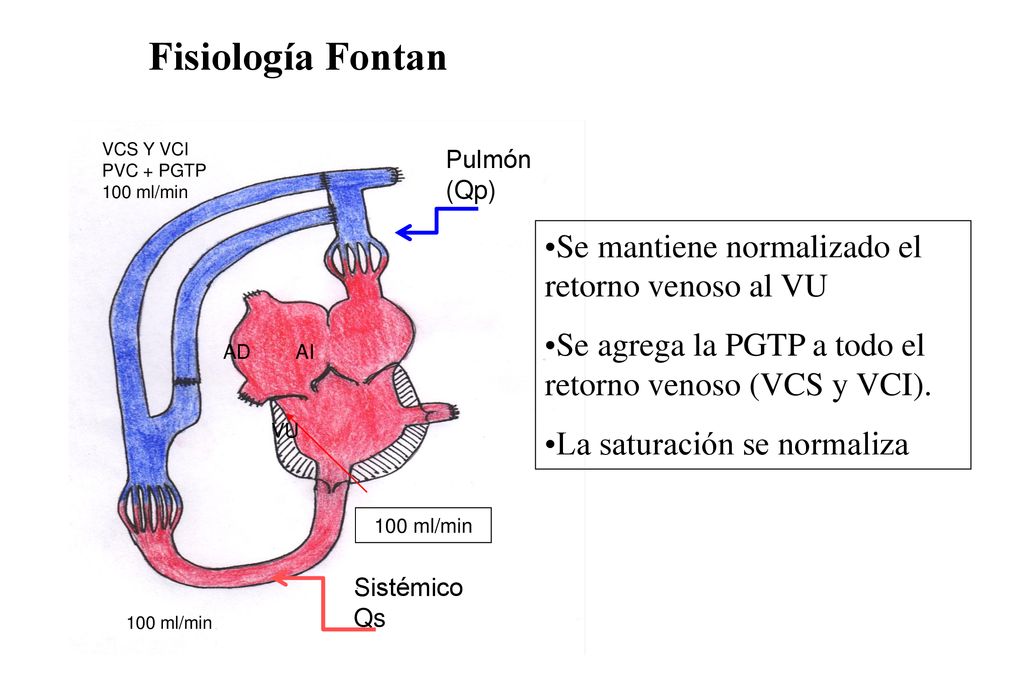 Fisiología Fontan Se mantiene normalizado el retorno venoso al VU