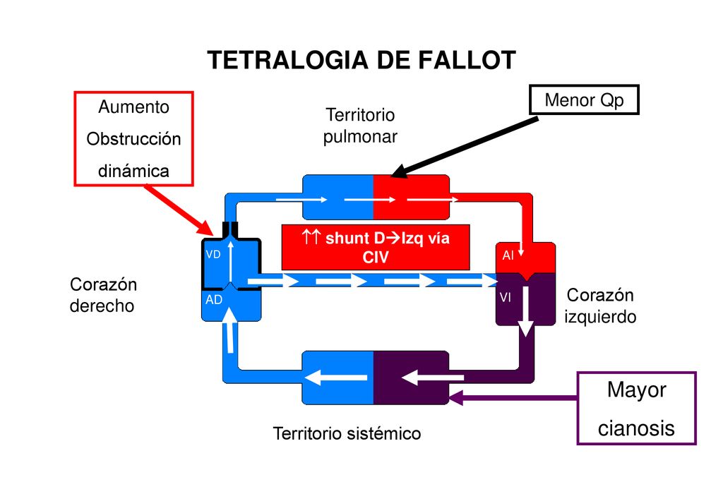 TETRALOGIA DE FALLOT Mayor cianosis Menor Qp Aumento
