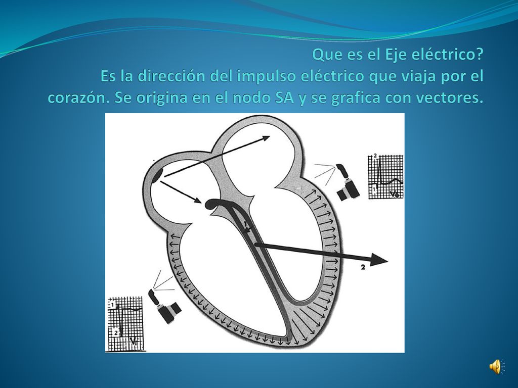Que es el Eje eléctrico. Es la dirección del impulso eléctrico que viaja por el corazón.