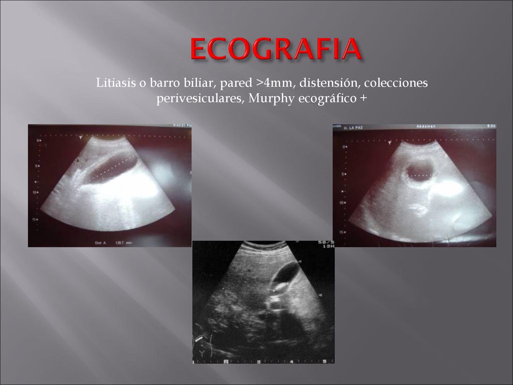 ECOGRAFIA Litiasis o barro biliar, pared >4mm, distensión, colecciones perivesiculares, Murphy ecográfico +
