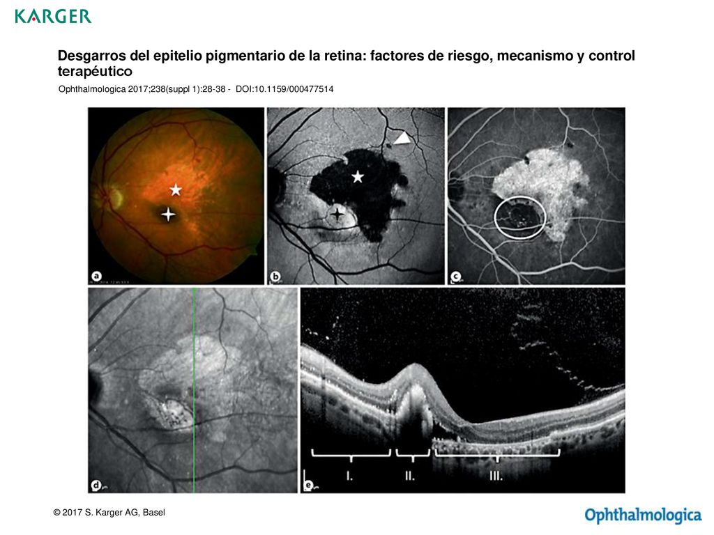 Desgarros del epitelio pigmentario de la retina: factores de riesgo, mecanismo y control terapéutico