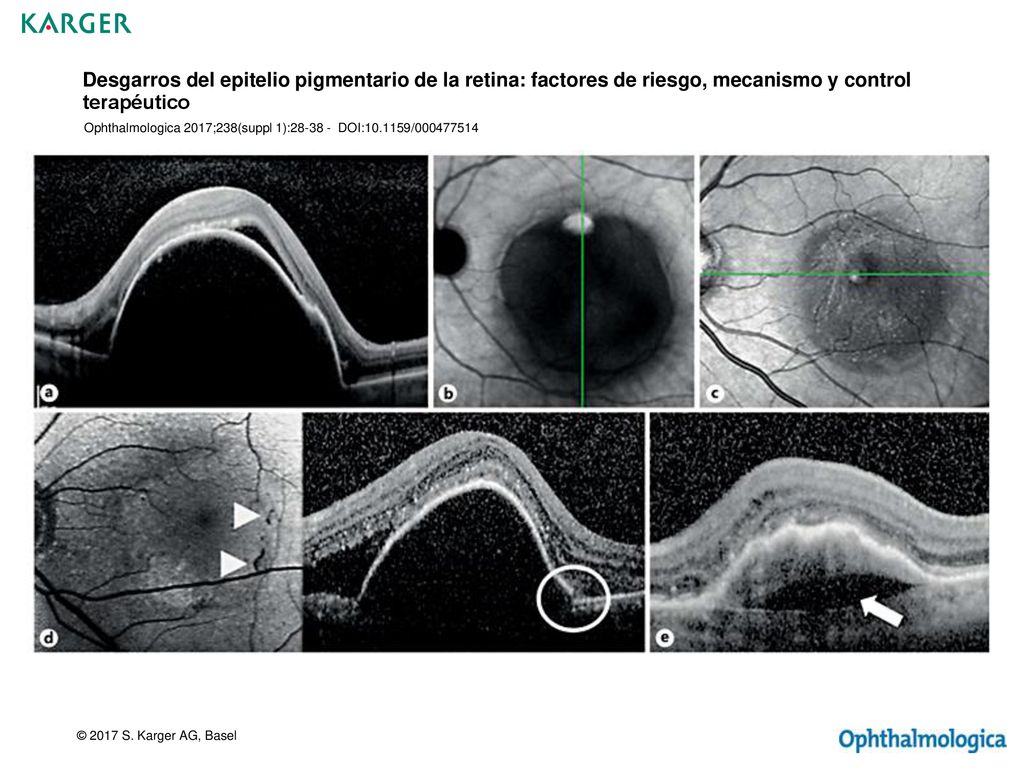 Desgarros del epitelio pigmentario de la retina: factores de riesgo, mecanismo y control terapéutico