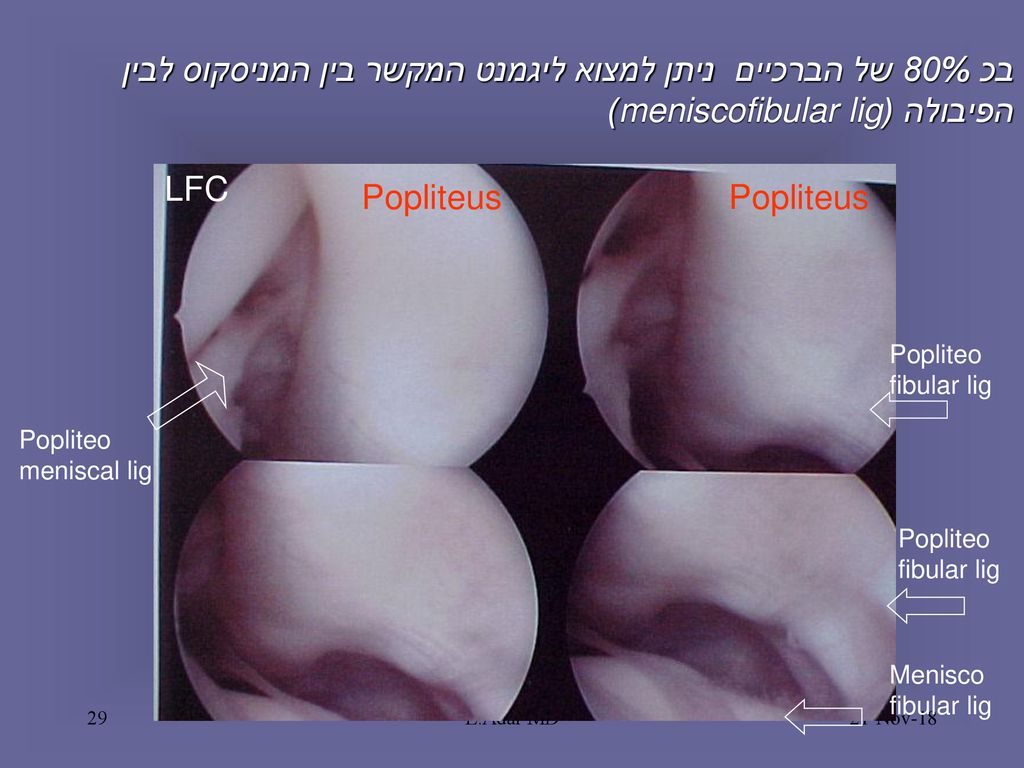 בכ 80% של הברכיים ניתן למצוא ליגמנט המקשר בין המניסקוס לבין הפיבולה (meniscofibular lig)