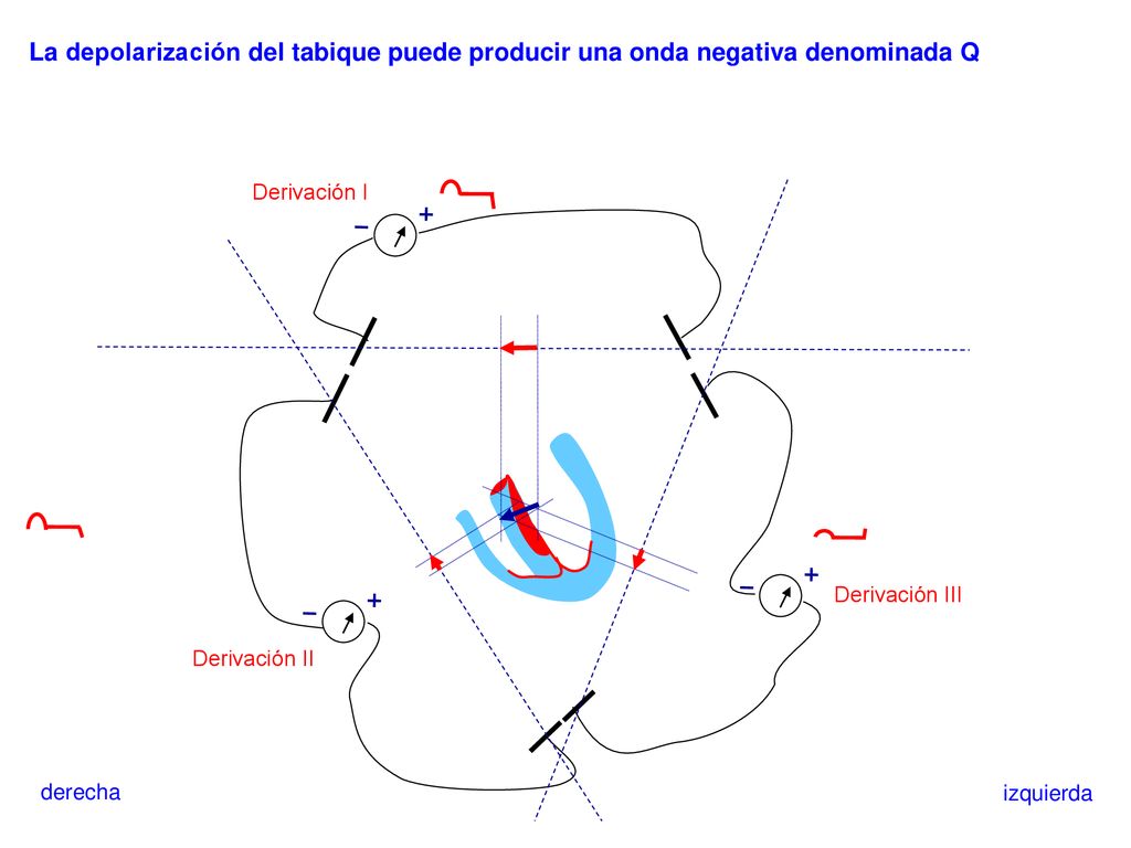 La depolarización del tabique puede producir una onda negativa denominada Q