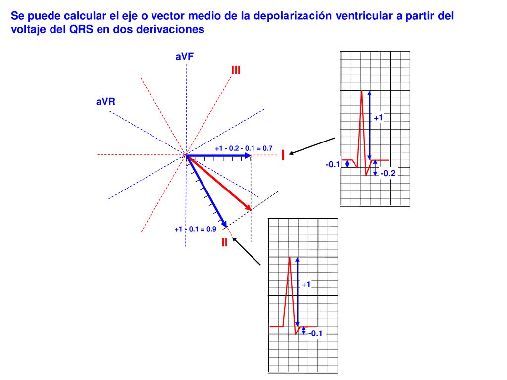 Se puede calcular el eje o vector medio de la depolarización ventricular a partir del voltaje del QRS en dos derivaciones